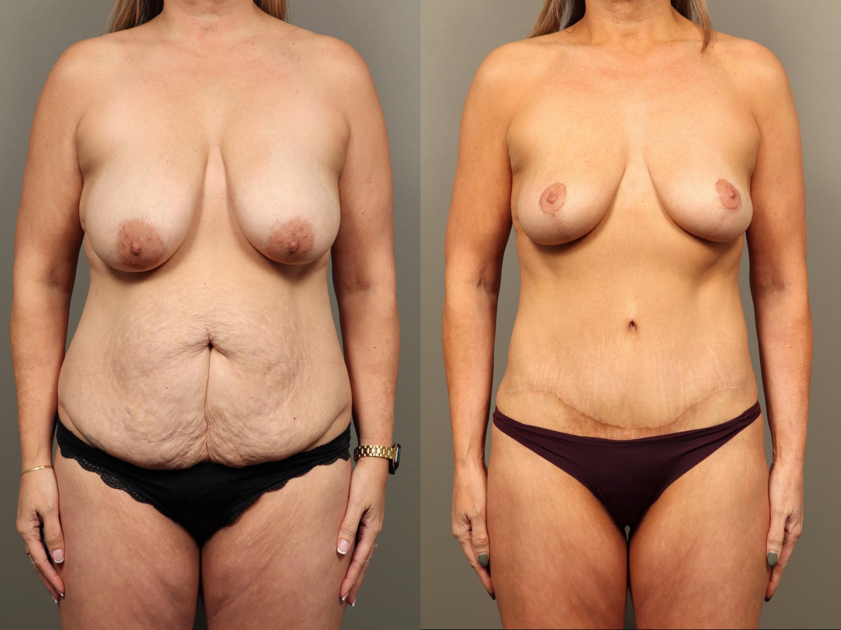 Before & After Breast Lift (No Implants) Case 502 Front View in Gilbert, AZ