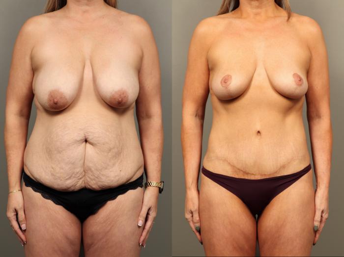 Before & After Breast Lift (No Implants) Case 502 Front View in Gilbert, AZ