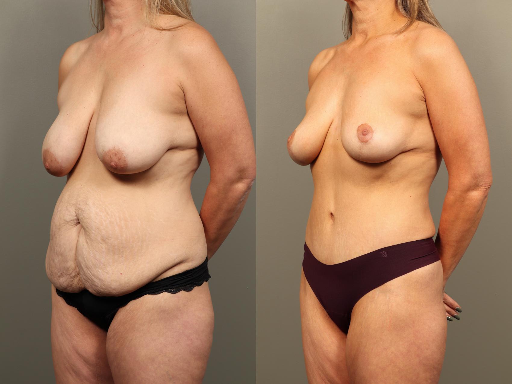 Before & After Breast Lift (No Implants) Case 502 Left Oblique View in Gilbert, AZ