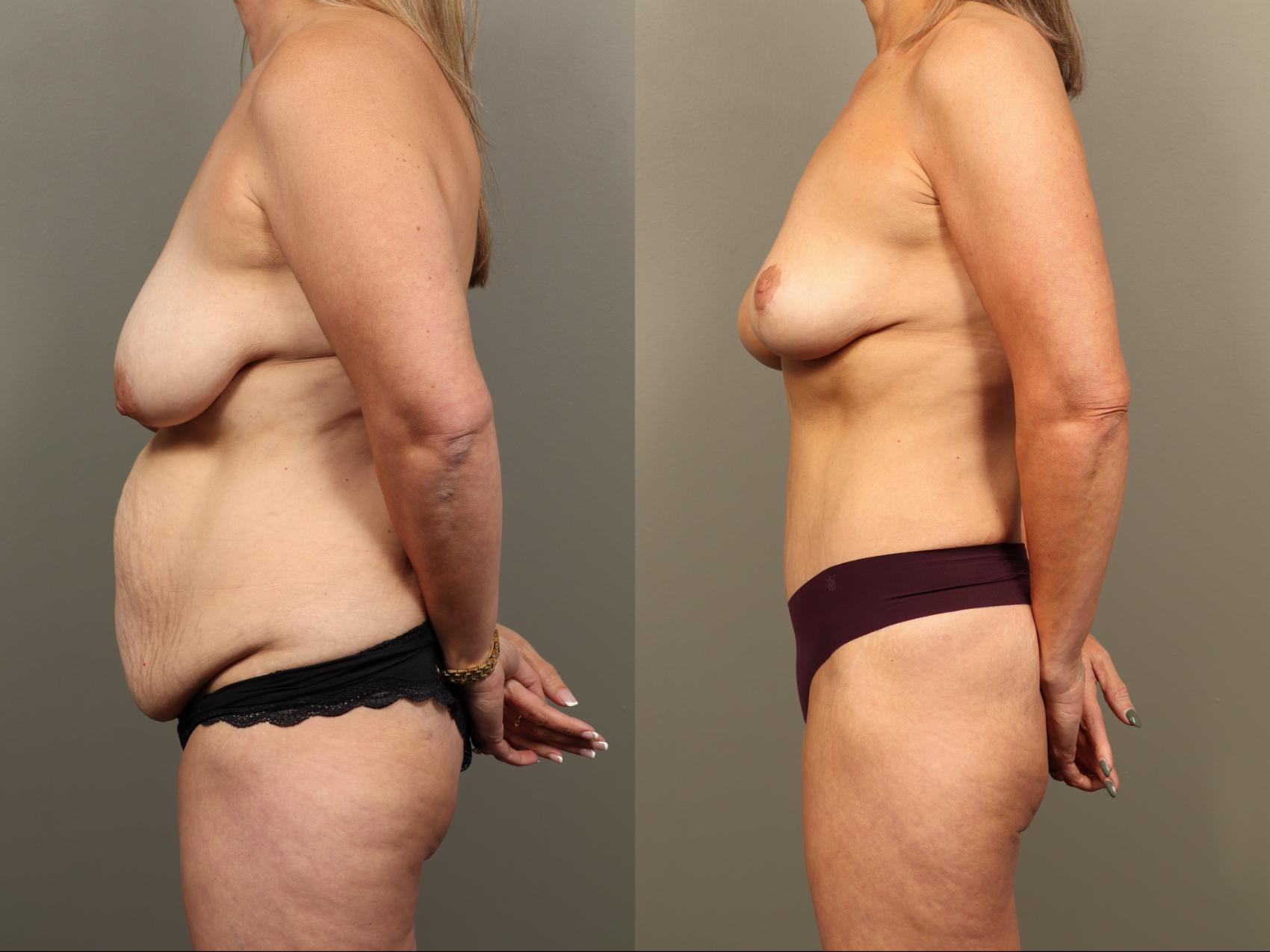 Before & After Breast Lift (No Implants) Case 502 Left Side View in Gilbert, AZ
