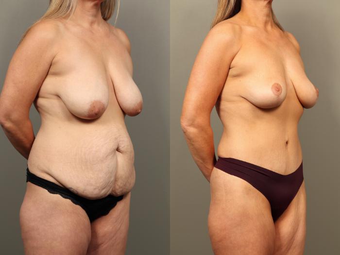 Before & After Breast Lift (No Implants) Case 502 Right Oblique View in Gilbert, AZ