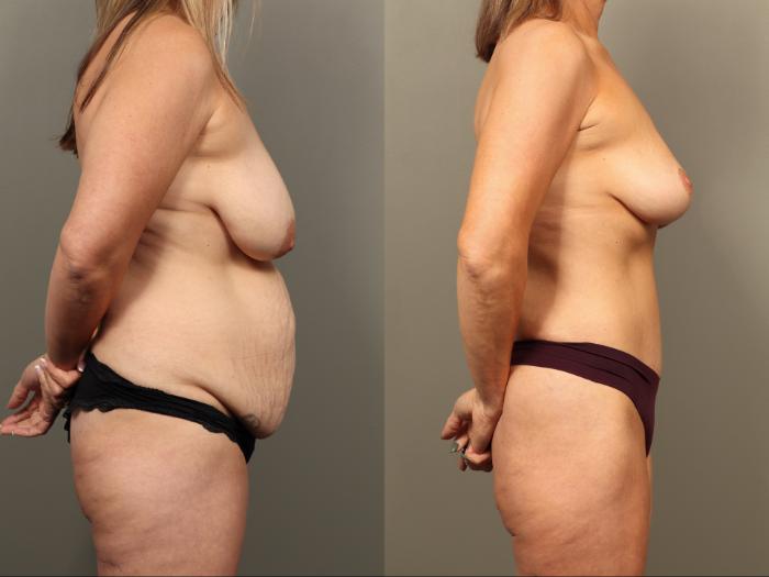Before & After Breast Lift (No Implants) Case 502 Right Side View in Gilbert, AZ