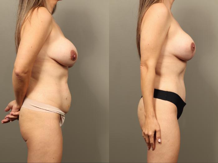 Before & After Mommy Makeover Case 507 Left Side View in Gilbert, AZ