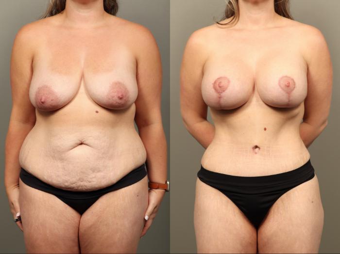 Before & After Mommy Makeover Case 514 Front View in Gilbert, AZ