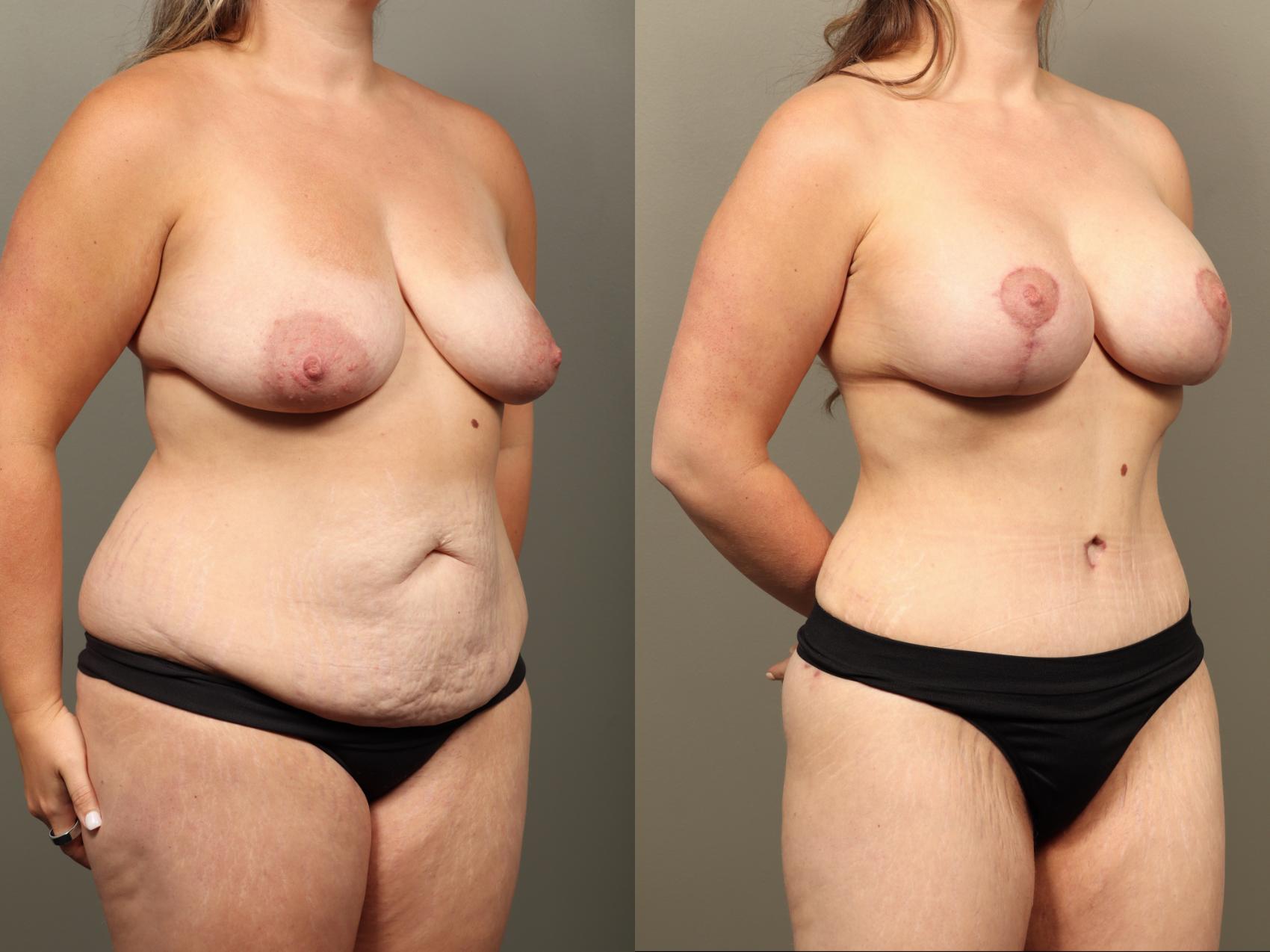 Before & After Mommy Makeover Case 514 Left Oblique View in Gilbert, AZ
