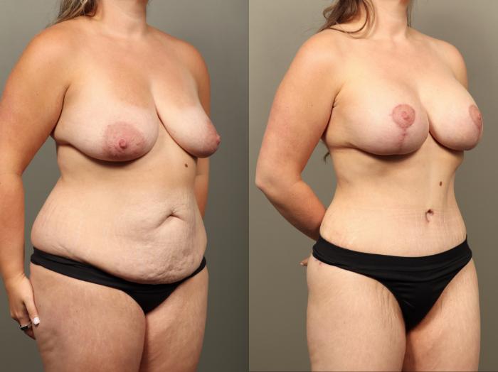 Before & After Mommy Makeover Case 514 Left Oblique View in Gilbert, AZ