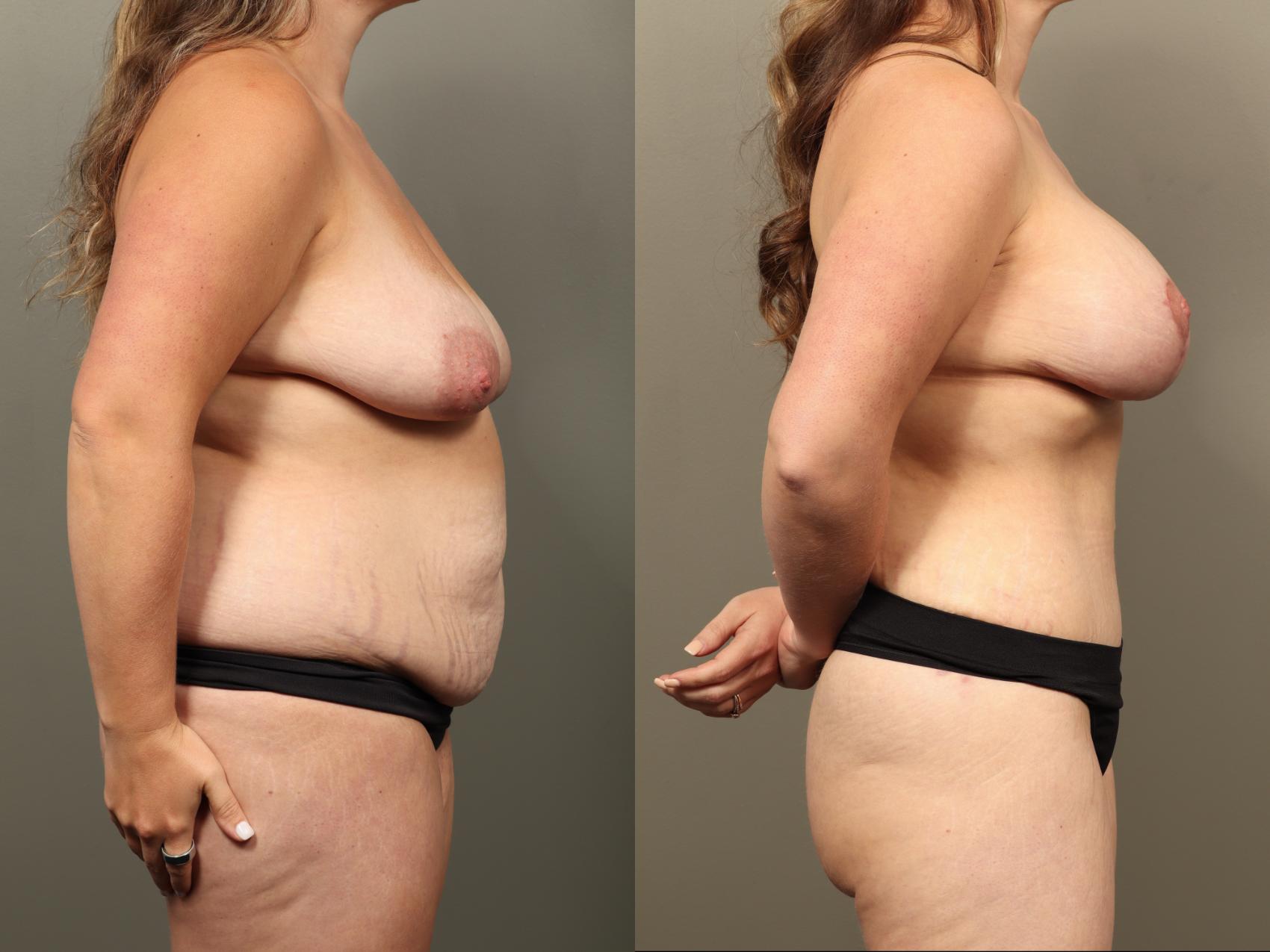 Before & After Mommy Makeover Case 514 Left Side View in Gilbert, AZ