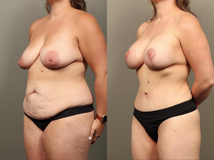 Before & After Mommy Makeover Case 514 Right Oblique View in Gilbert, AZ