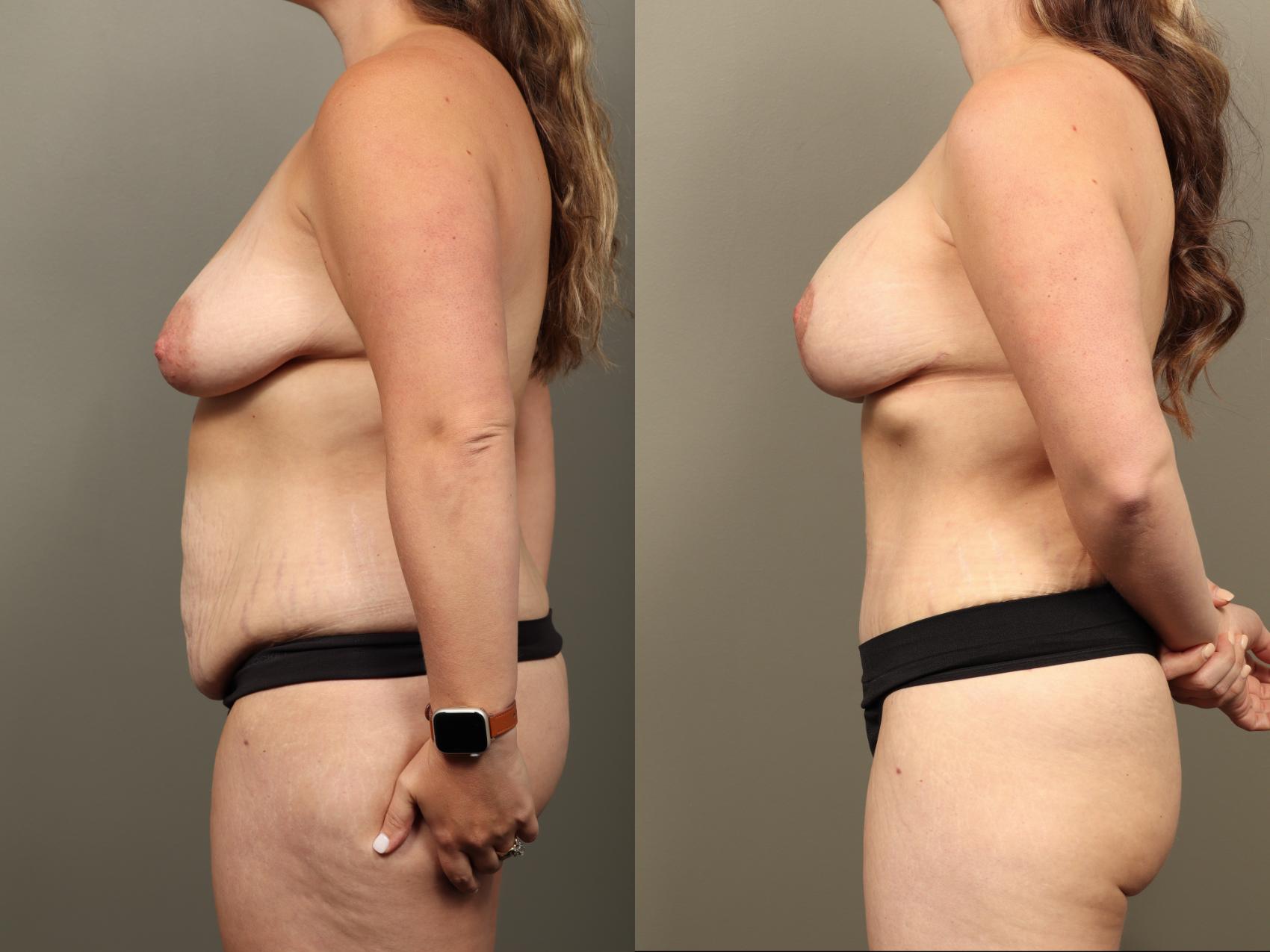 Before & After Mommy Makeover Case 514 Right Side View in Gilbert, AZ