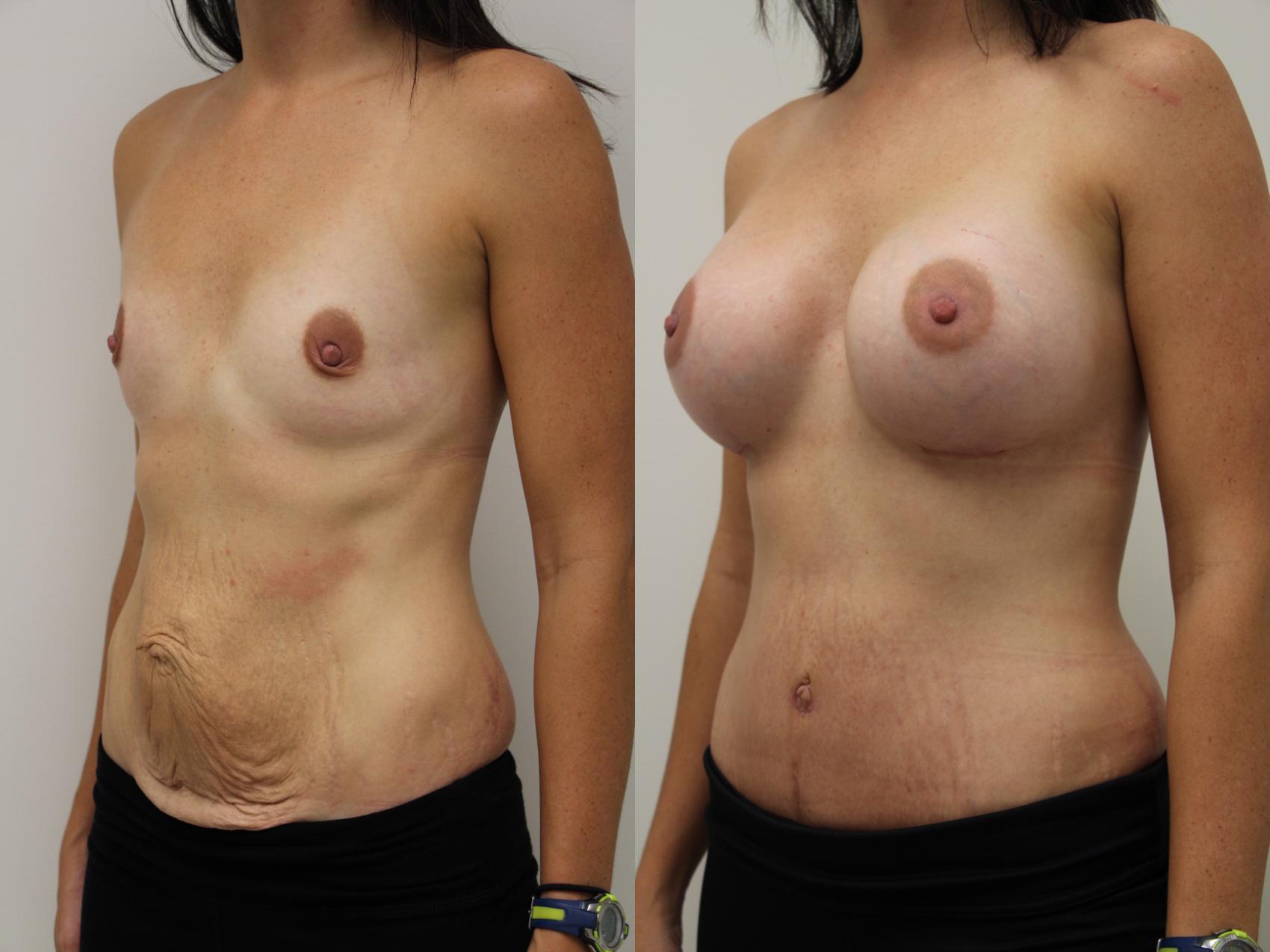 Before & After Mommy Makeover Case 58 View #2 View in Gilbert, AZ