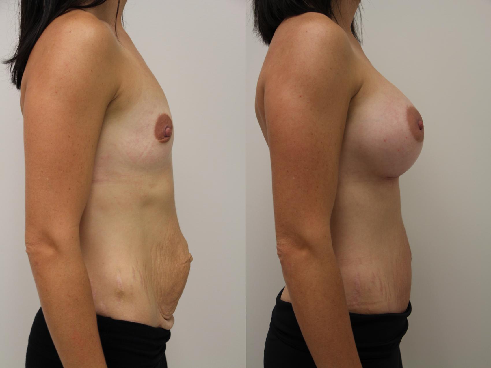 Before & After Mommy Makeover Case 58 View #3 View in Gilbert, AZ