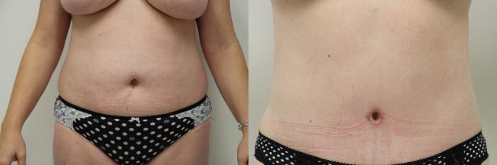 Before & After Tummy Tuck (Abdominoplasty) Case 67 View #1 View in Gilbert, AZ