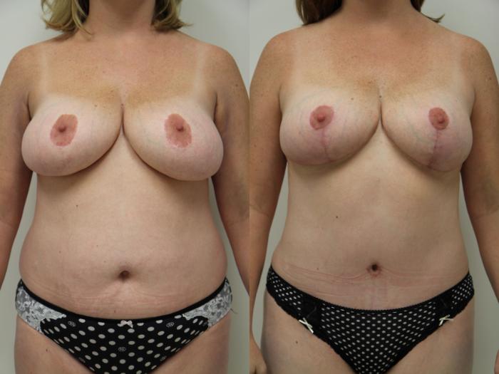 Before & After Breast Reduction Case 67 View #2 View in Gilbert, AZ