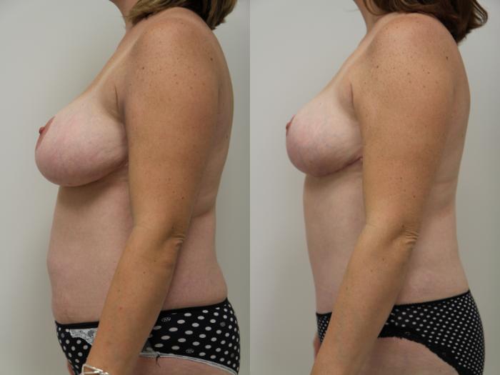 Before & After Breast Reduction Case 67 View #3 View in Gilbert, AZ