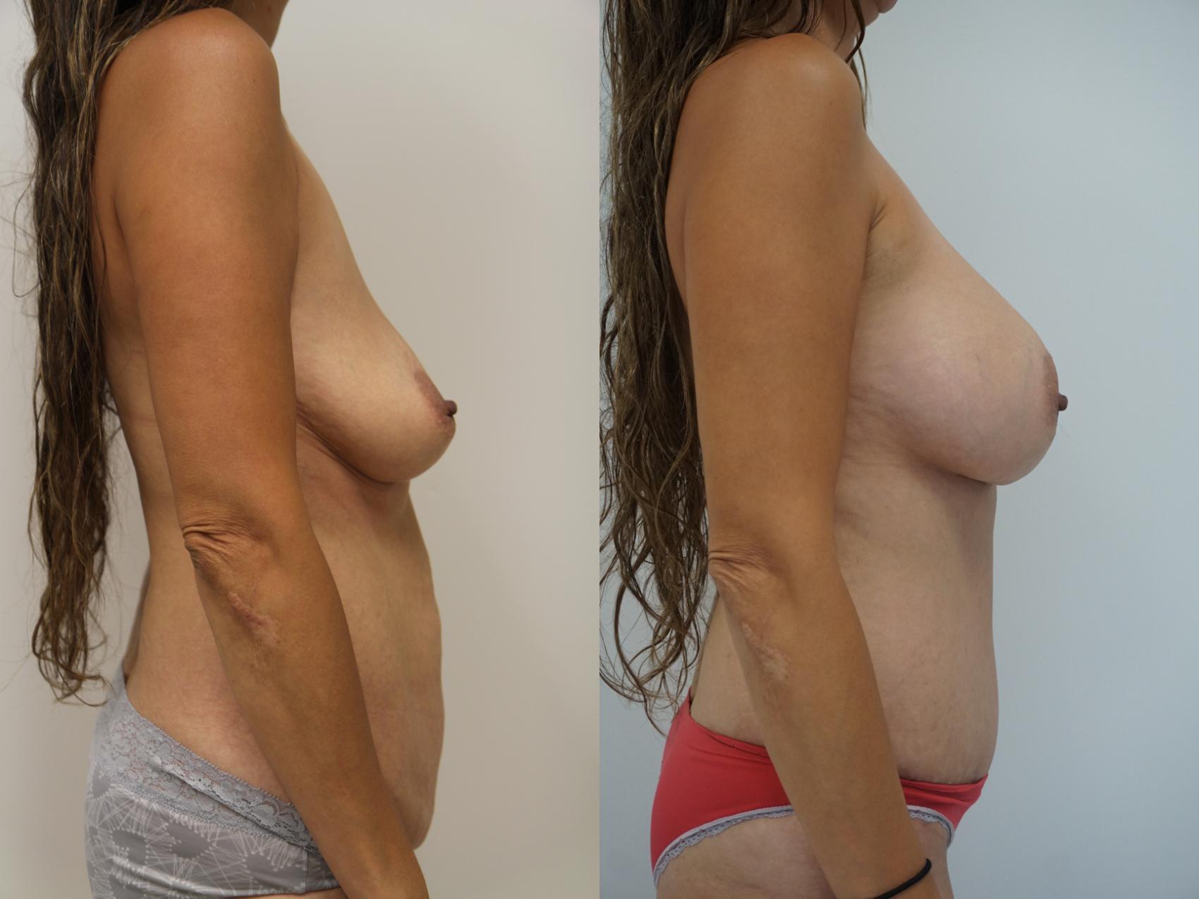 Before & After Mommy Makeover Case 80 View #3 View in Gilbert, AZ