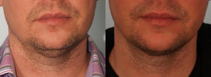 Before & After Neck Contouring Case 65 View #1 View in Gilbert, AZ