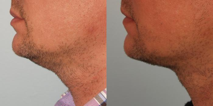 Before & After Neck Contouring Case 65 View #2 View in Gilbert, AZ