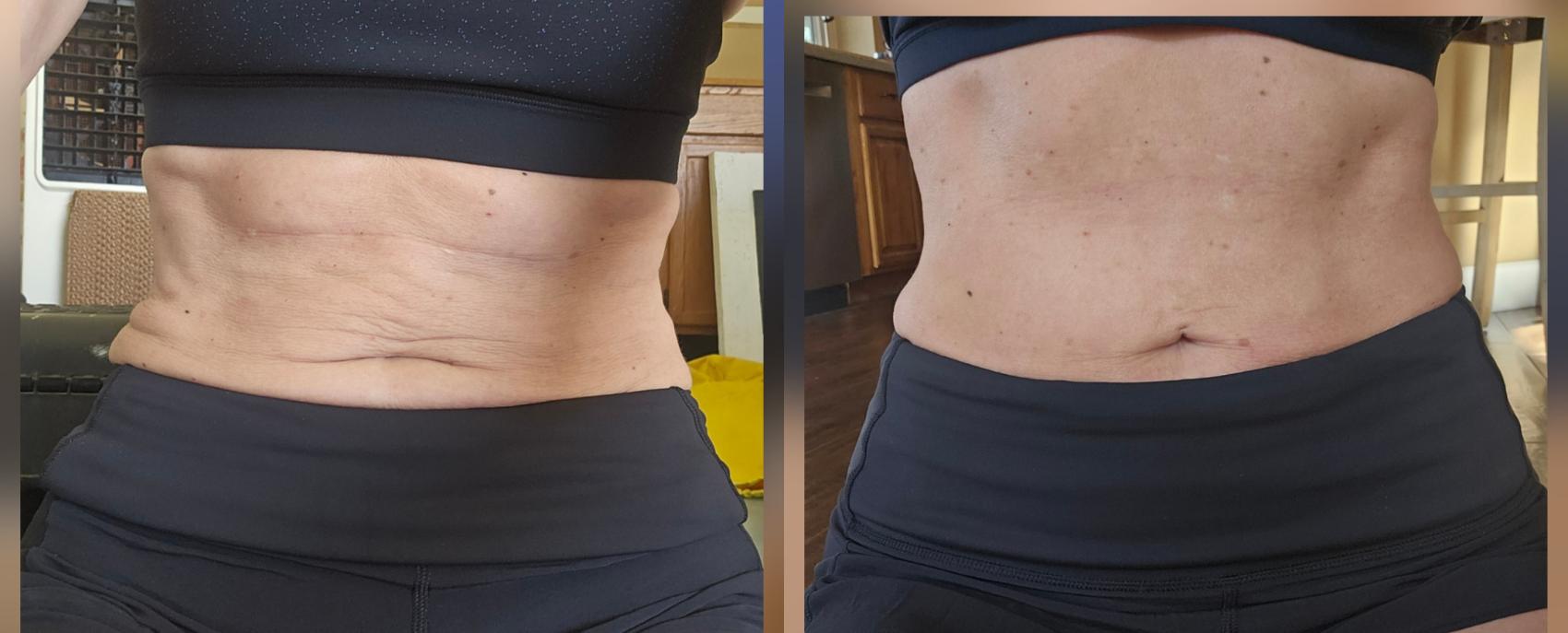 Before & After Quantum/Renuvion Case 515 Front View in Gilbert, AZ