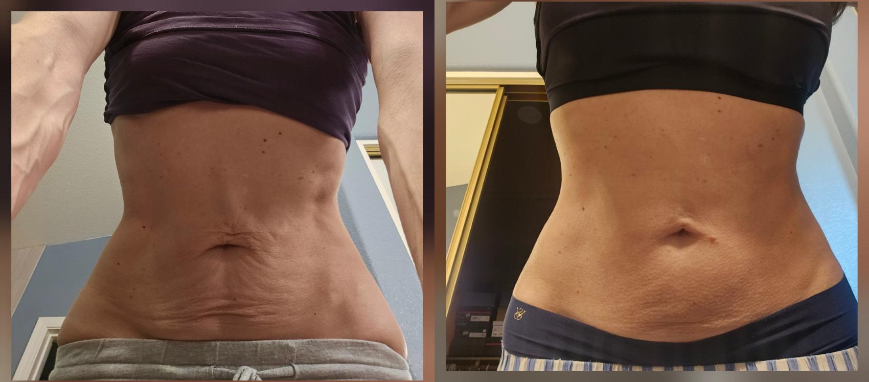 Before & After Quantum/Renuvion Case 515 Front Leaning Over View in Gilbert, AZ