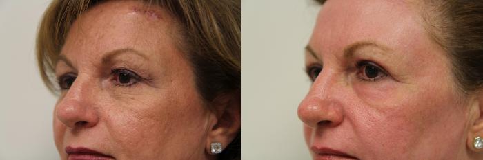 Before & After Renuvion J-Plasma Skin Tightening Case 112 View #3 View in Gilbert, AZ
