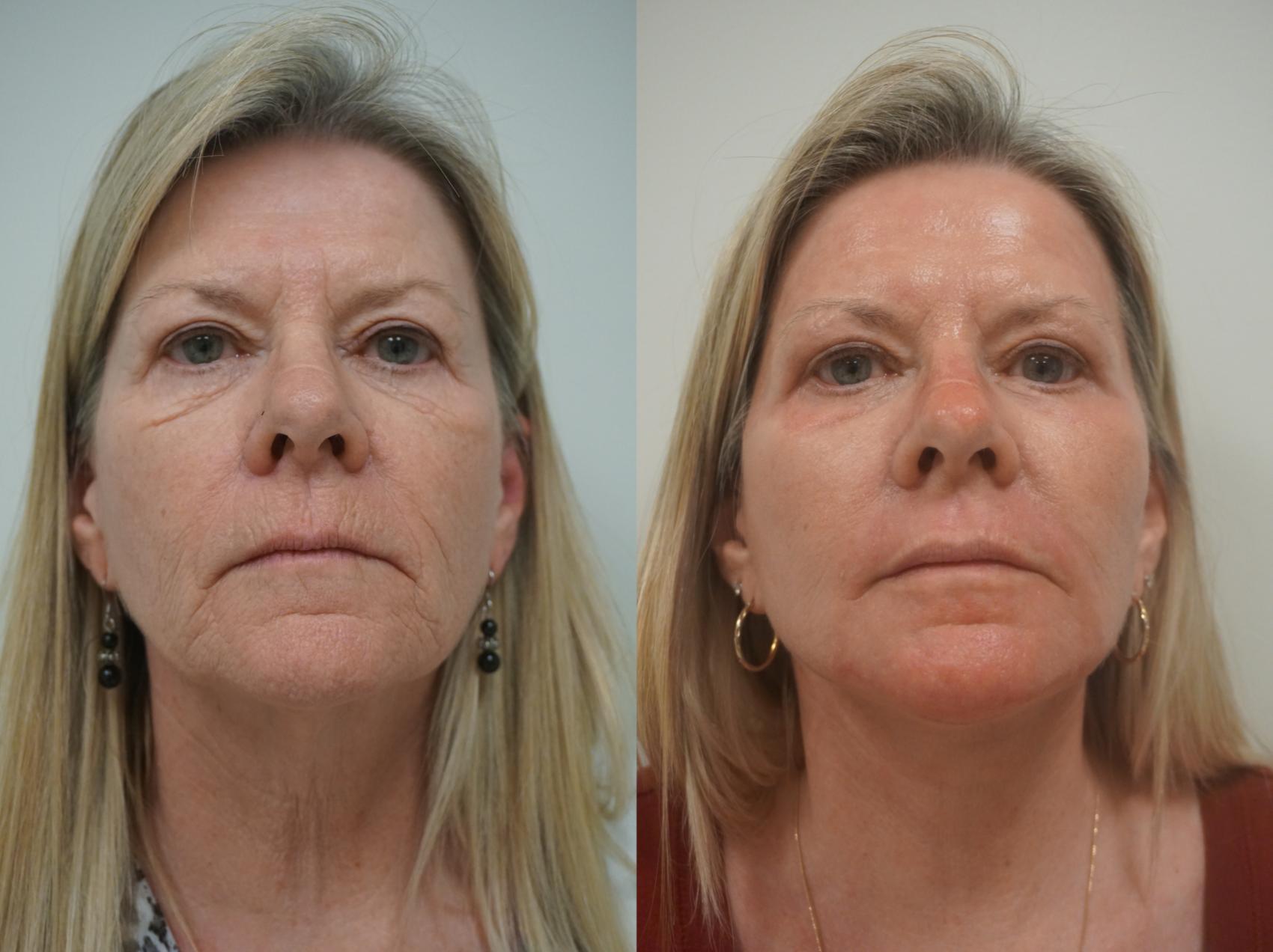 Before & After Renuvion J-Plasma Skin Tightening Case 113 View #2 View in Gilbert, AZ