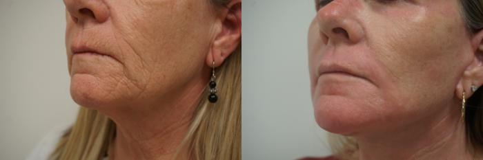 Before & After Renuvion J-Plasma Skin Tightening Case 113 View #3 View in Gilbert, AZ