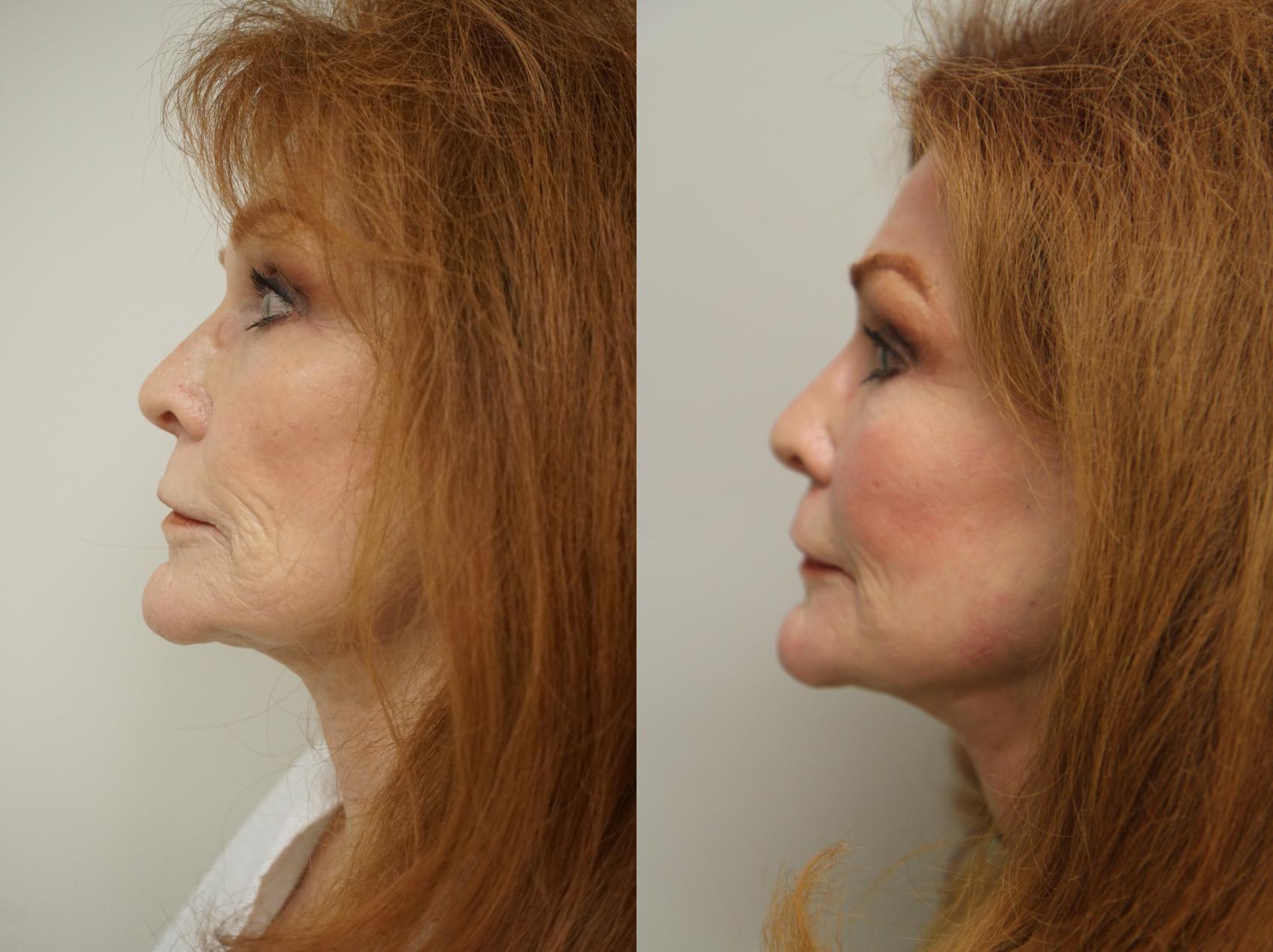 Before & After Renuvion J-Plasma Skin Tightening Case 135 View #2 View in Gilbert, AZ