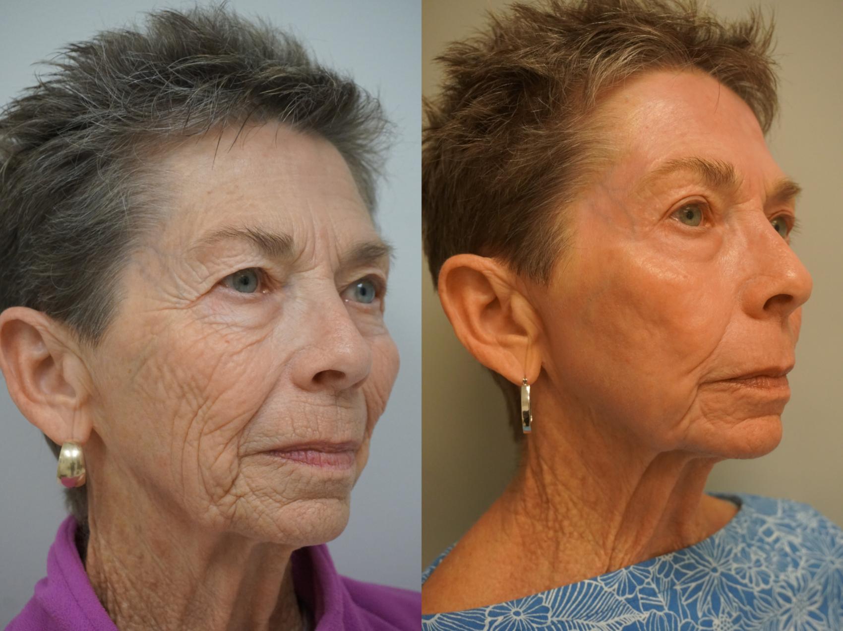 Before & After Renuvion J-Plasma Skin Tightening Case 159 View #1 View in Gilbert, AZ