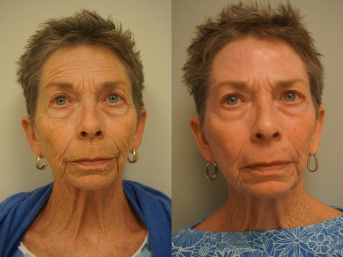 Before & After Renuvion J-Plasma Skin Tightening Case 159 View #2 View in Gilbert, AZ