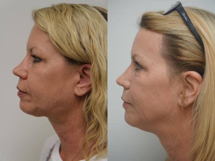 Before & After Renuvion J-Plasma Skin Tightening Case 95 View #3 View in Gilbert, AZ