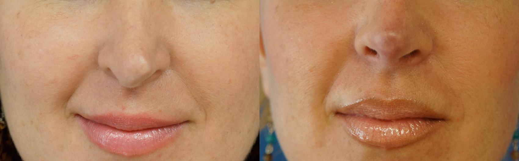 Before & After Rhinoplasty Case 2 View #1 View in Gilbert, AZ