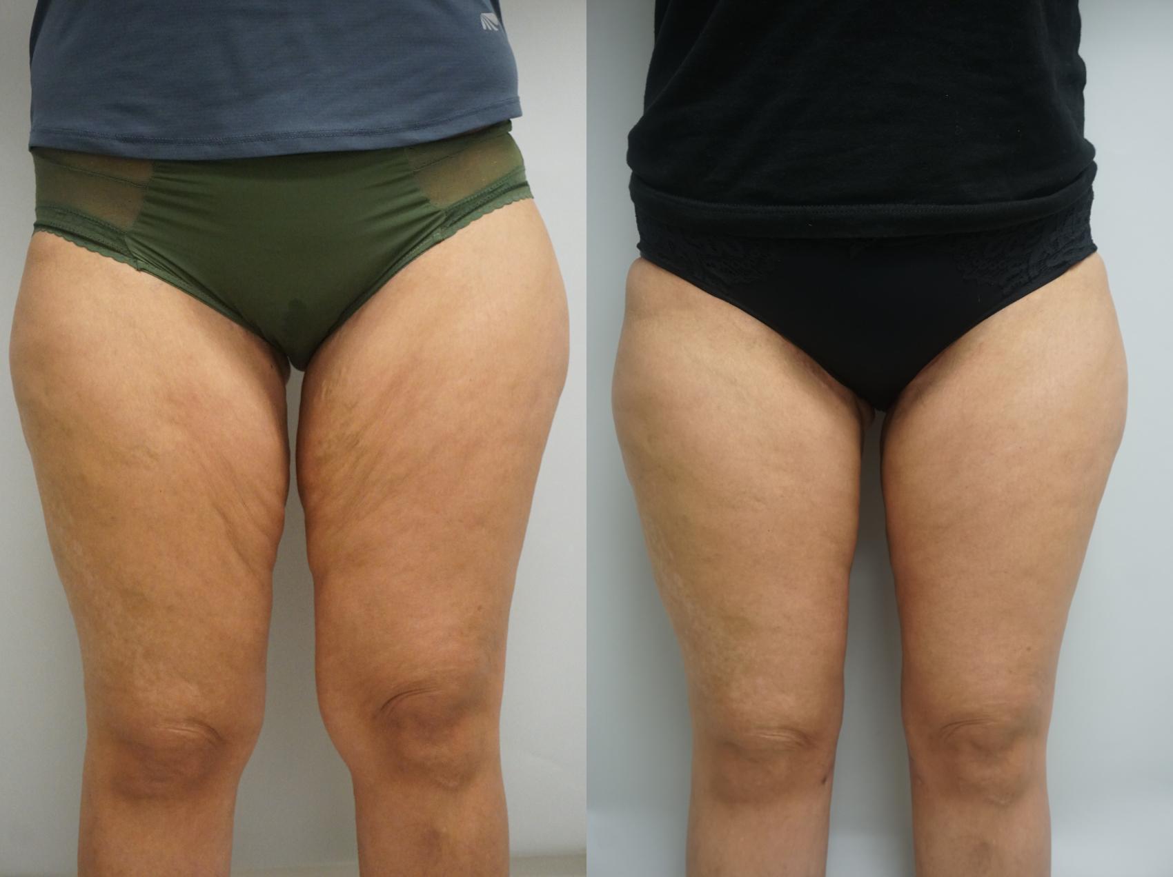Before & After Liposuction Case 314 Front View in Gilbert, AZ