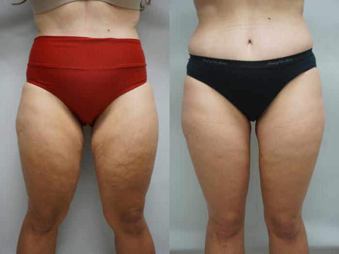 Before & After Thigh Lift Case 334 Front View in Gilbert, AZ