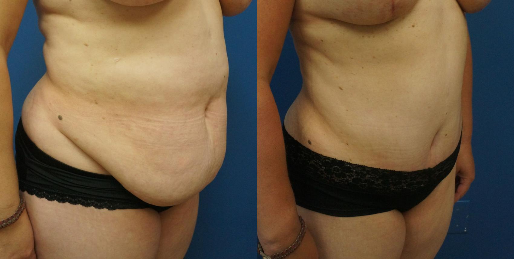Before & After Tummy Tuck (Abdominoplasty) Case 12 View #1 View in Gilbert, AZ