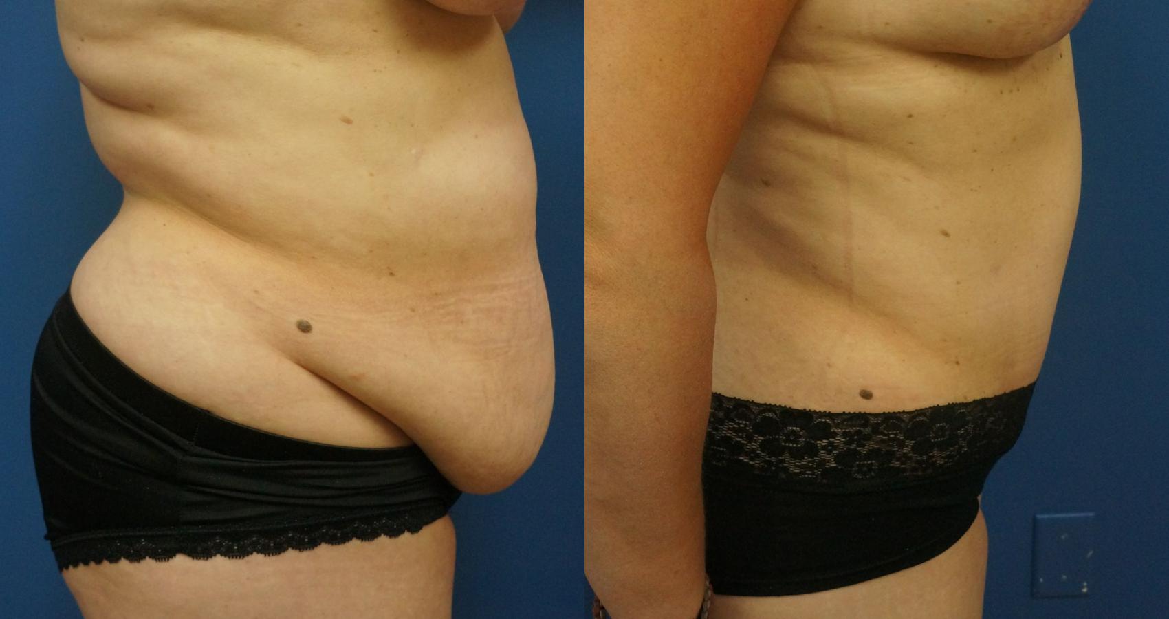 Before & After Abdominoplasty (Tummy Tuck) Case 12 View #2 View in Gilbert, AZ