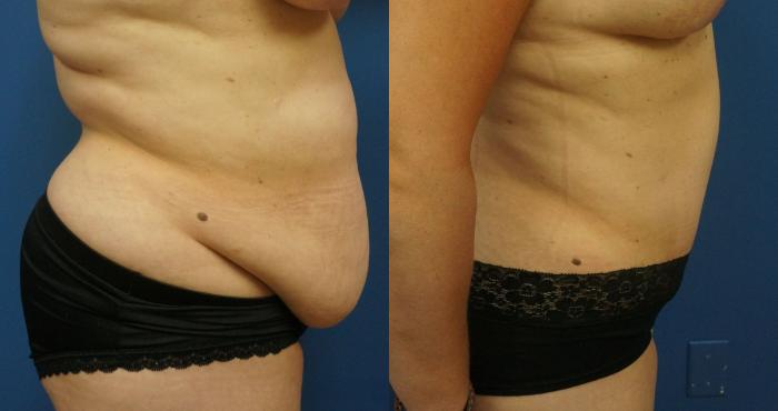 Before & After Tummy Tuck (Abdominoplasty) Case 12 View #2 View in Gilbert, AZ