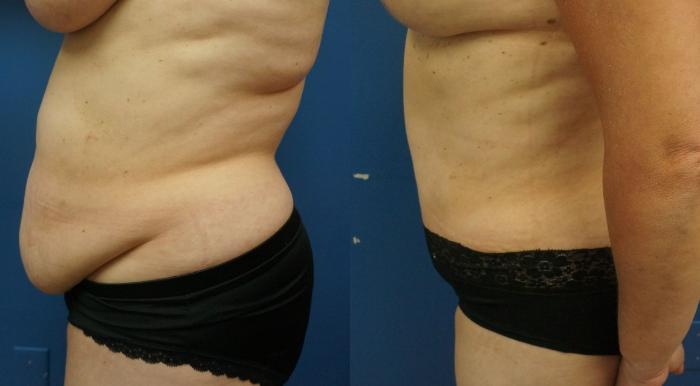 Before & After Tummy Tuck (Abdominoplasty) Case 12 View #3 View in Gilbert, AZ
