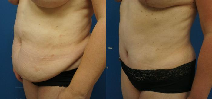 Before & After Tummy Tuck (Abdominoplasty) Case 12 View #4 View in Gilbert, AZ