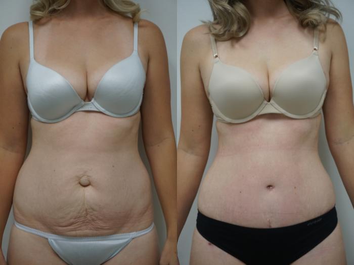 Before & After Tummy Tuck (Abdominoplasty) Case 128 View #1 View in Gilbert, AZ