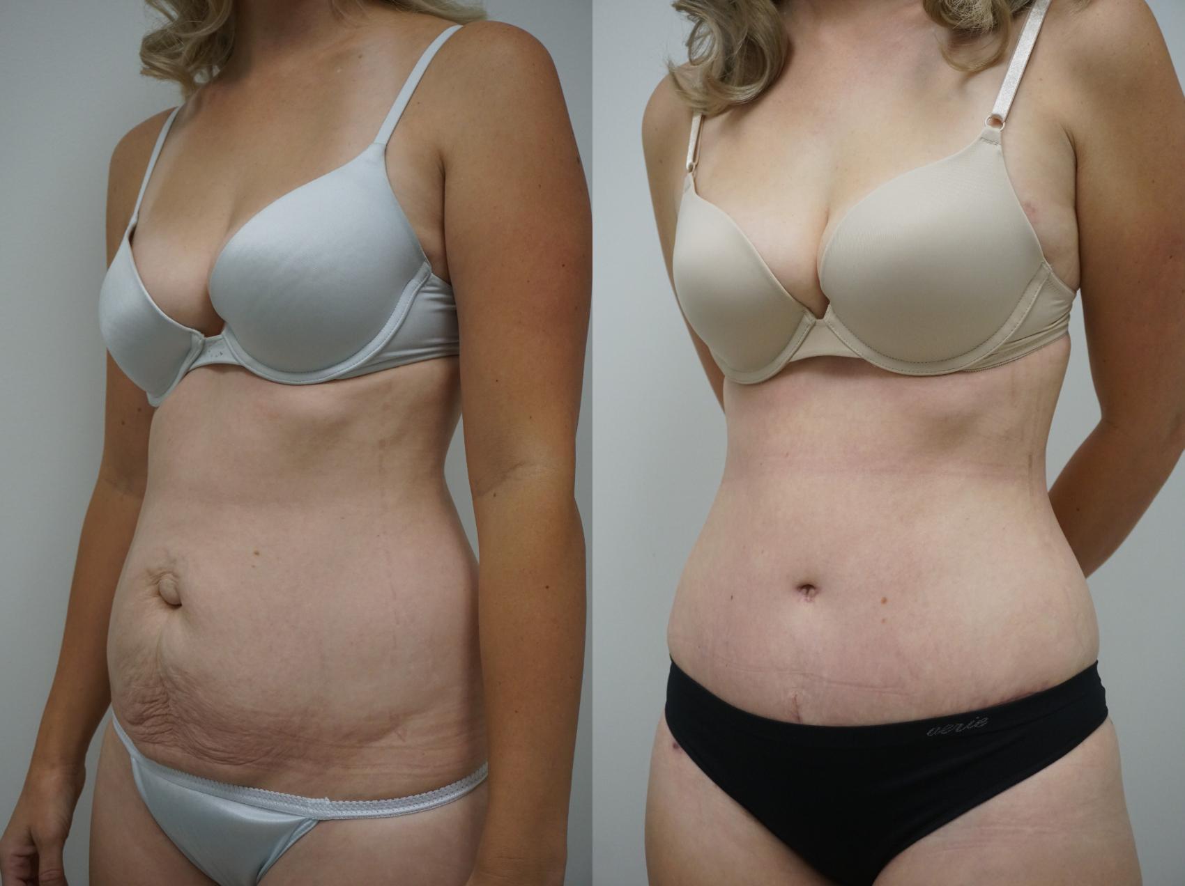 Before & After Tummy Tuck (Abdominoplasty) Case 128 View #2 View in Gilbert, AZ
