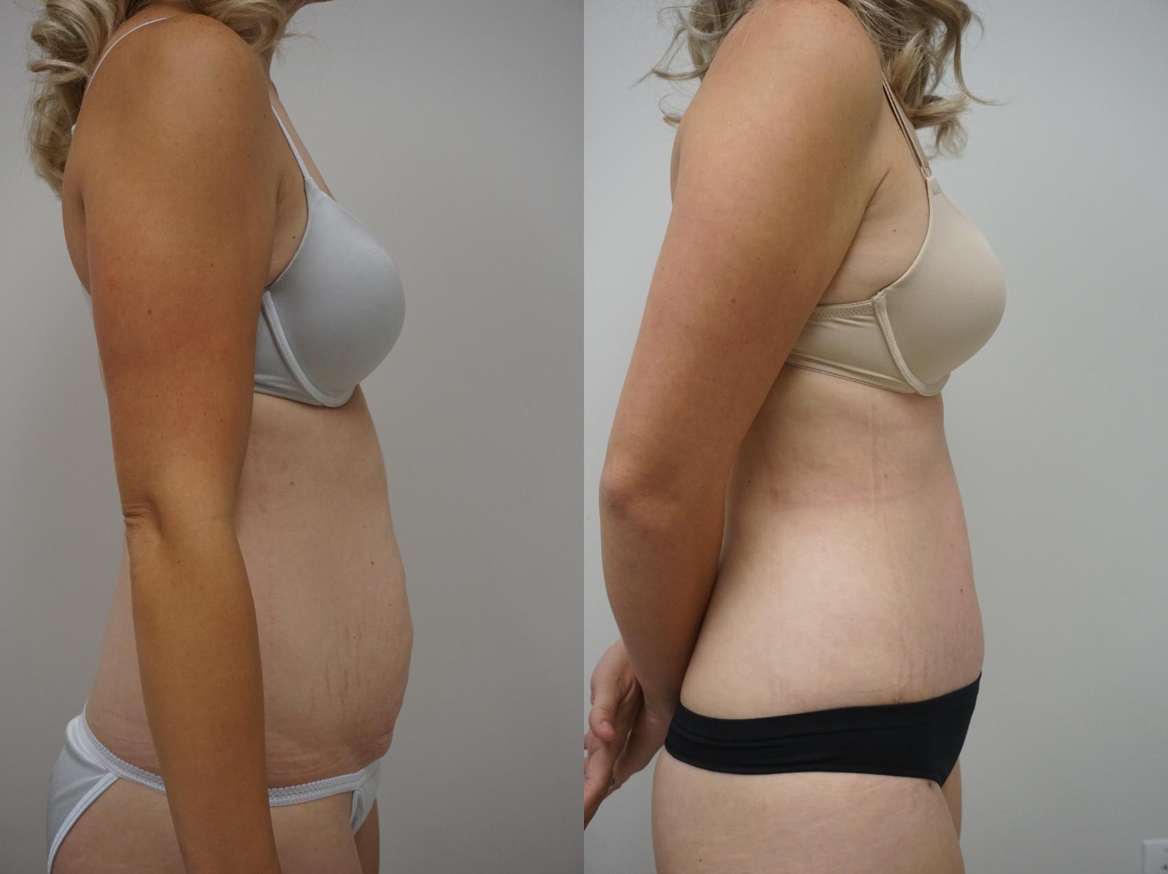 Before & After Tummy Tuck (Abdominoplasty) Case 128 View #3 View in Gilbert, AZ