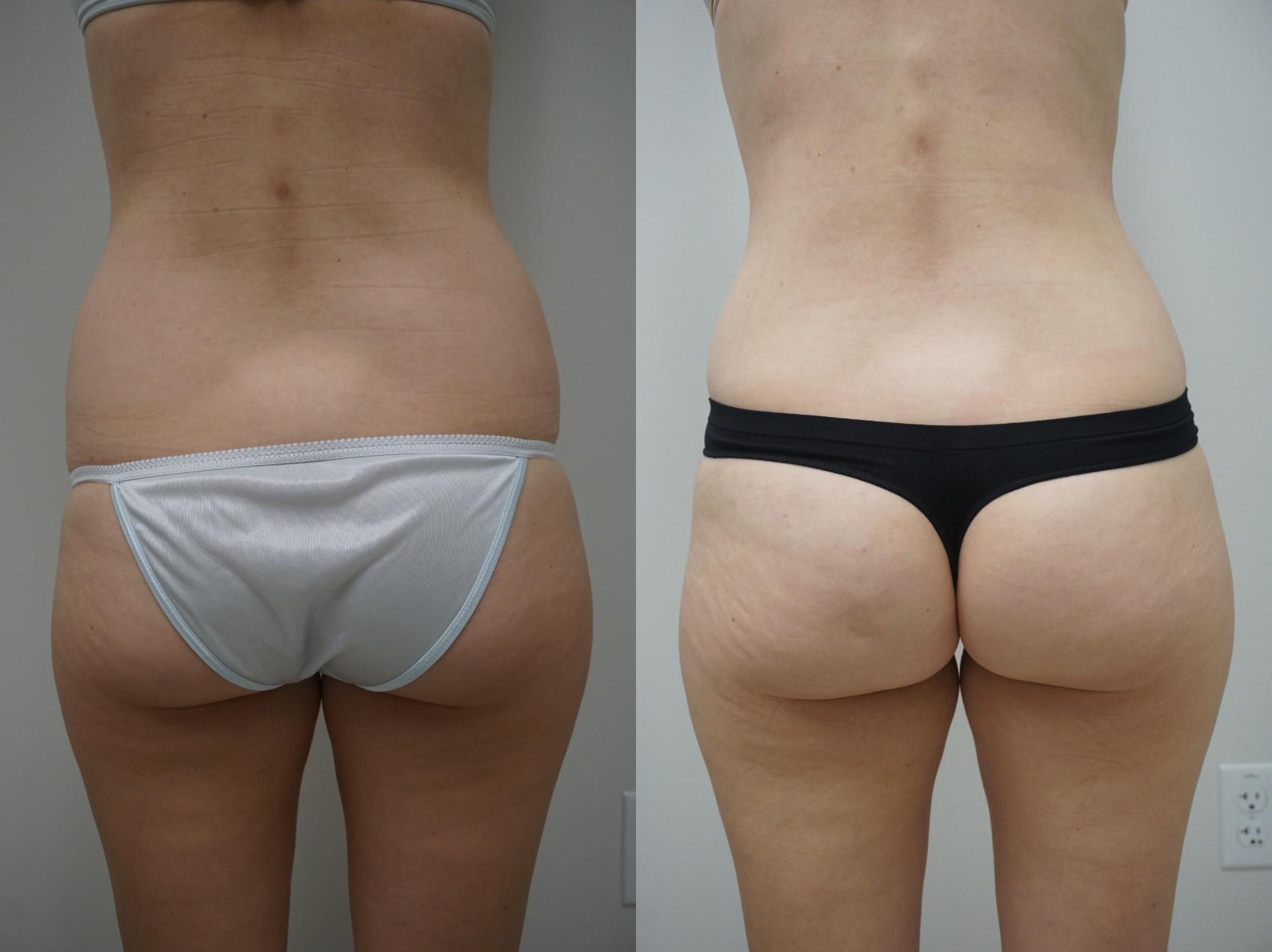 Before & After Abdominoplasty (Tummy Tuck) Case 128 View #4 View in Gilbert, AZ