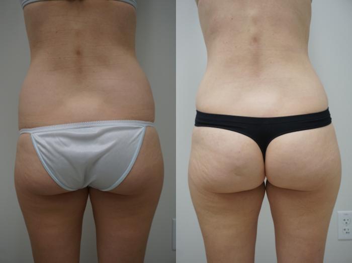 Before & After Tummy Tuck (Abdominoplasty) Case 128 View #4 View in Gilbert, AZ