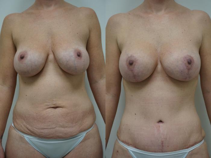 Before & After Tummy Tuck (Abdominoplasty) Case 157 View #1 View in Gilbert, AZ