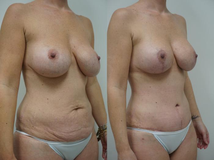 Before & After Tummy Tuck (Abdominoplasty) Case 157 View #2 View in Gilbert, AZ