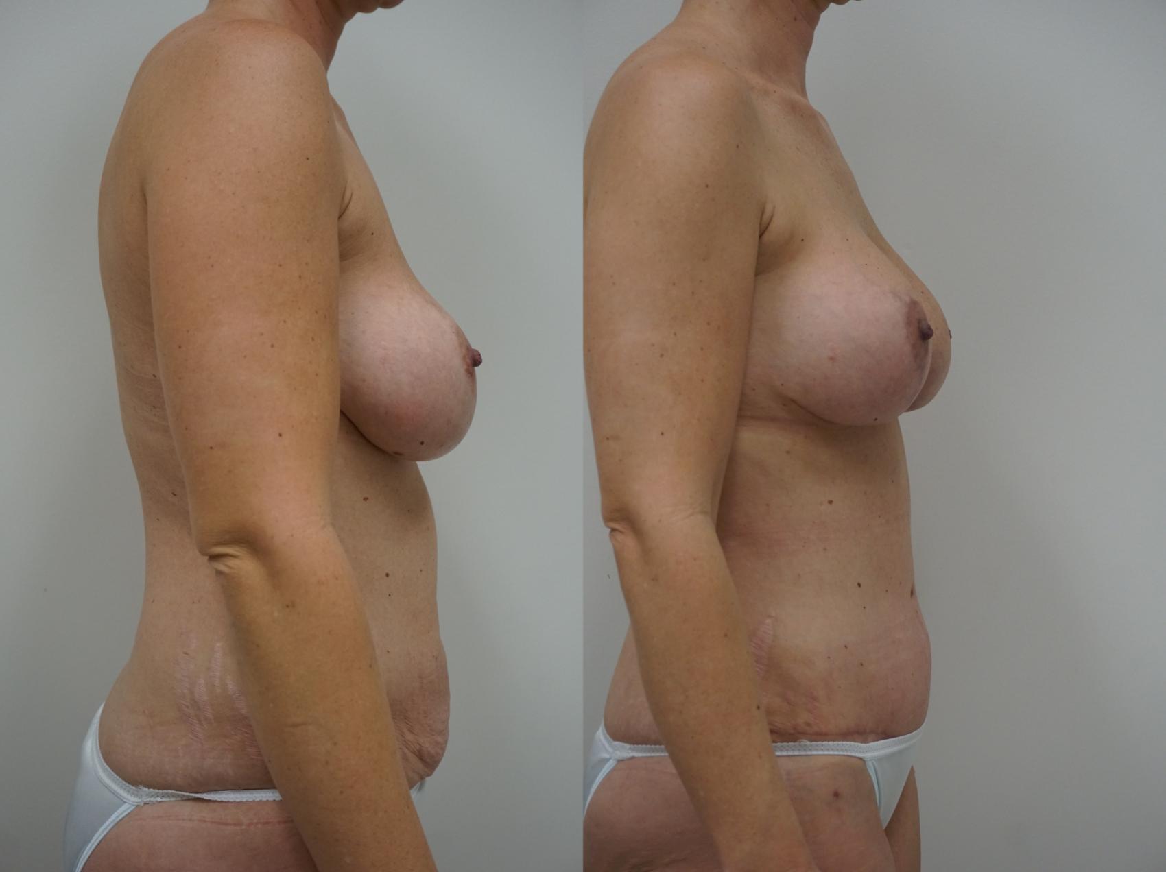 Before & After Tummy Tuck (Abdominoplasty) Case 157 View #3 View in Gilbert, AZ