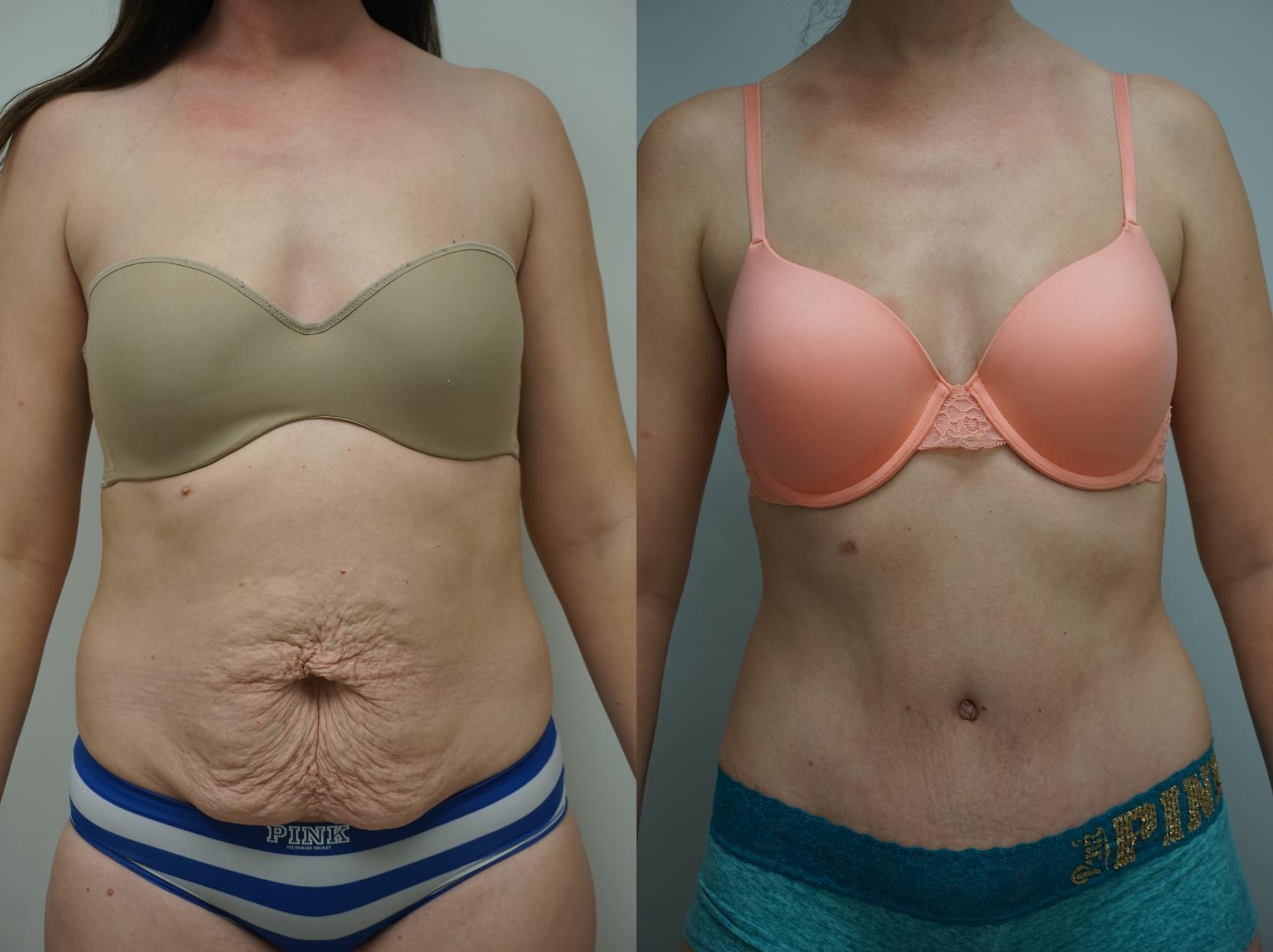 Tummy Tuck (Abdominoplasty) Before and After Pictures Case 183