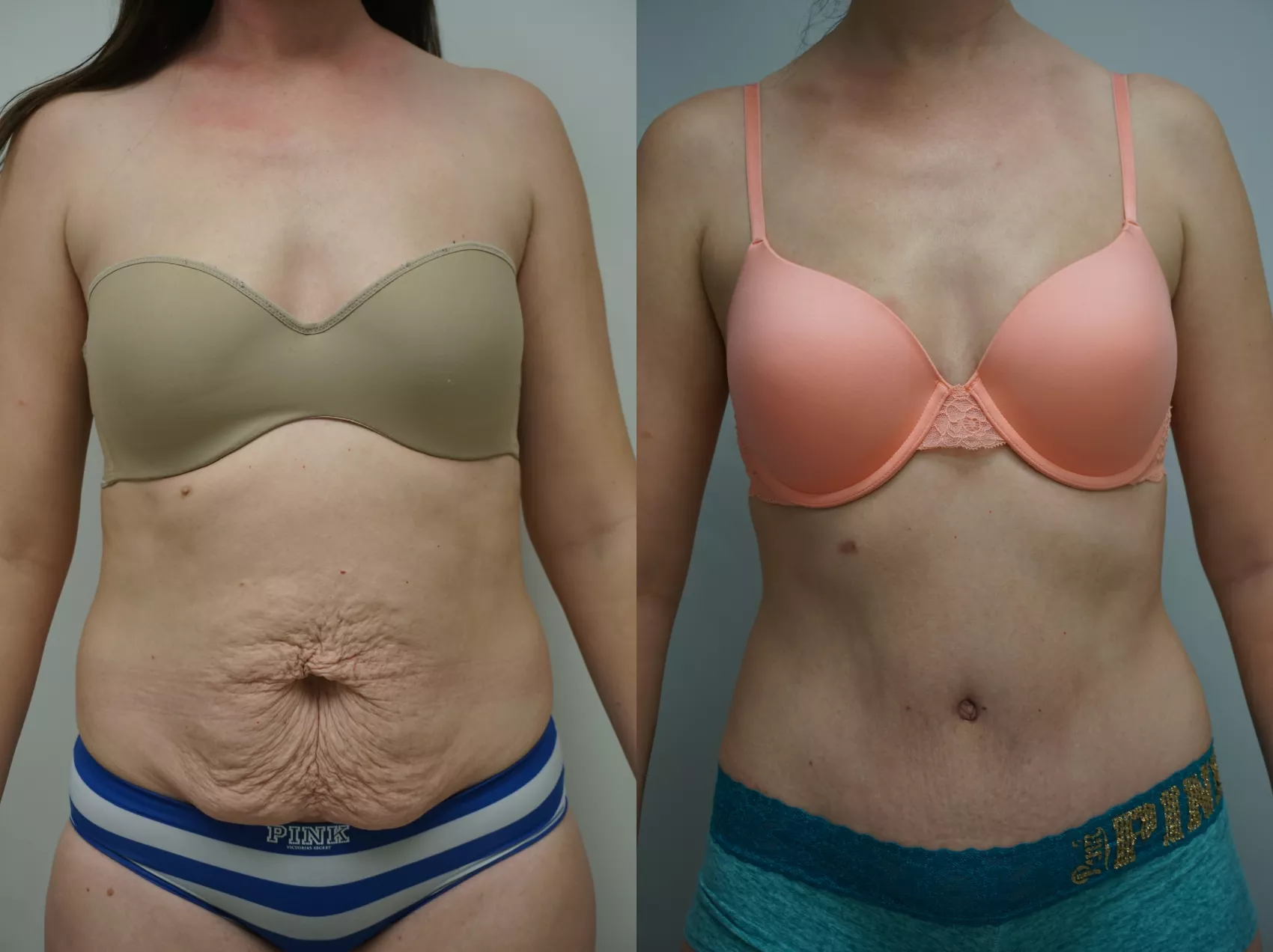 Tummy Tuck (Abdominoplasty) Before and After Pictures Case 97, Gilbert, AZ