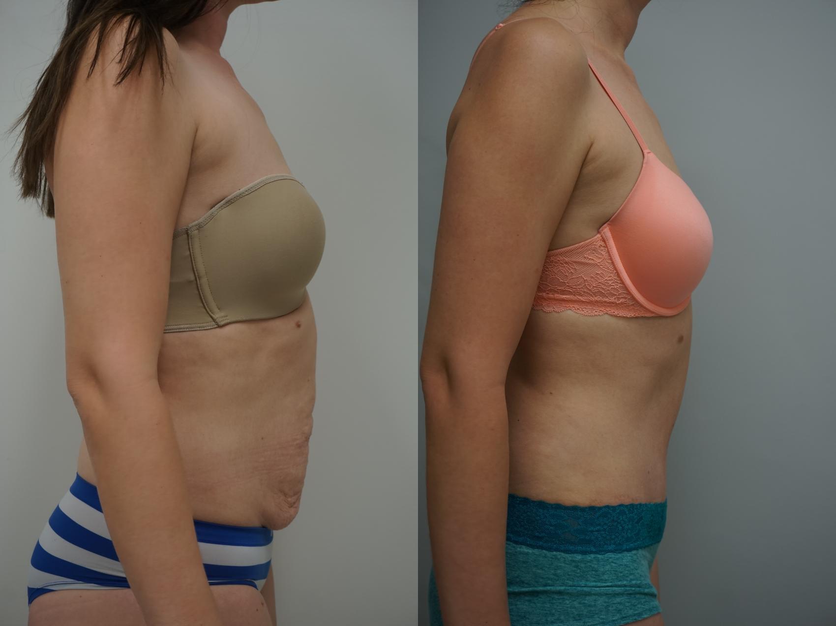 Before & After Tummy Tuck (Abdominoplasty) Case 183 View #2 View in Gilbert, AZ