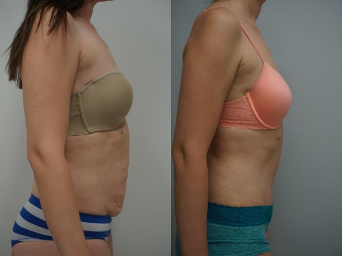 Abdominoplasty (Tummy Tuck) - Before and After Gallery - Dr Tavakoli